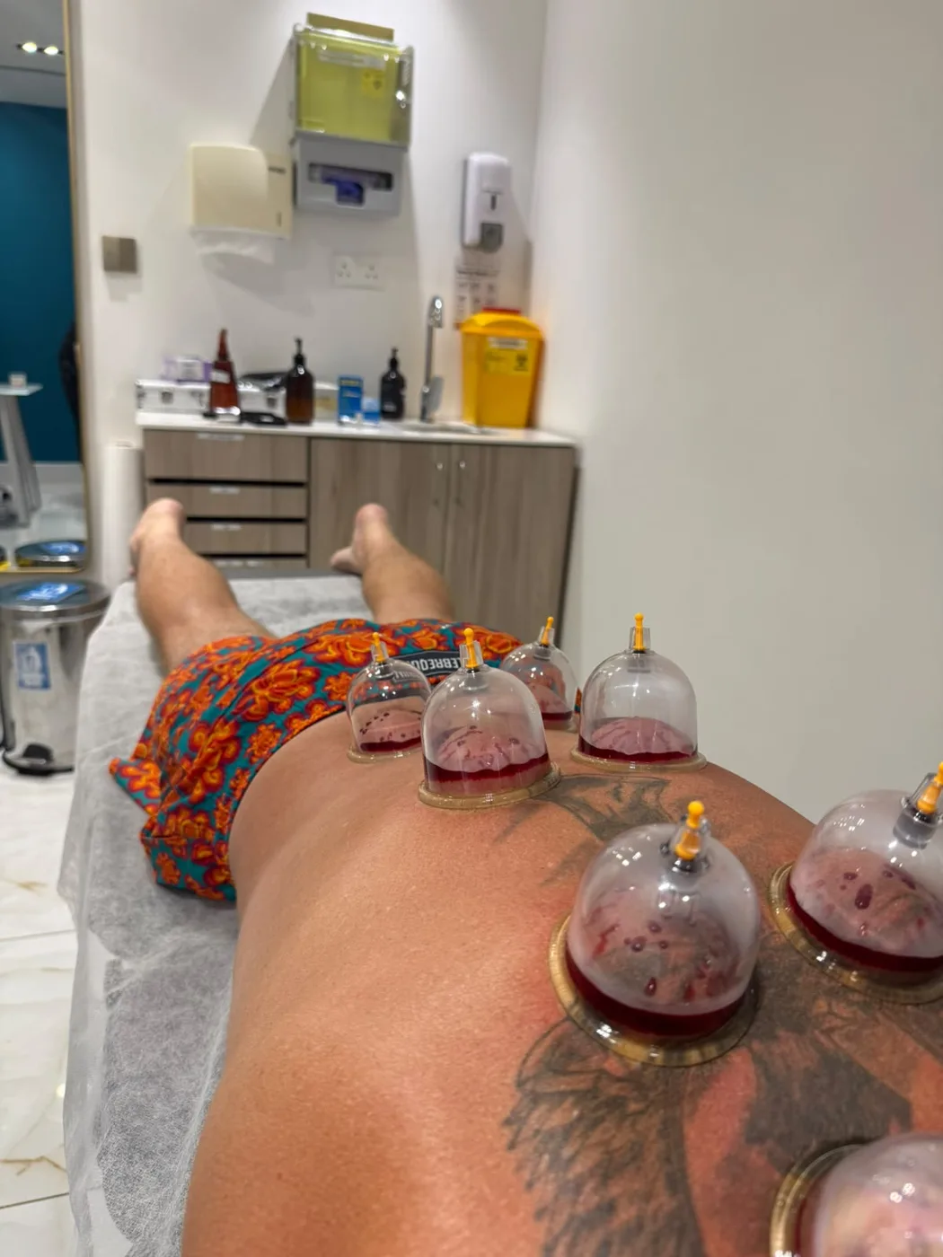 Bobby lying face down during a wet cupping session, with clear suction cups on his back.